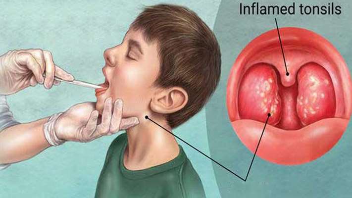 التهاب لوزه در کودکان و راه های درمان آن